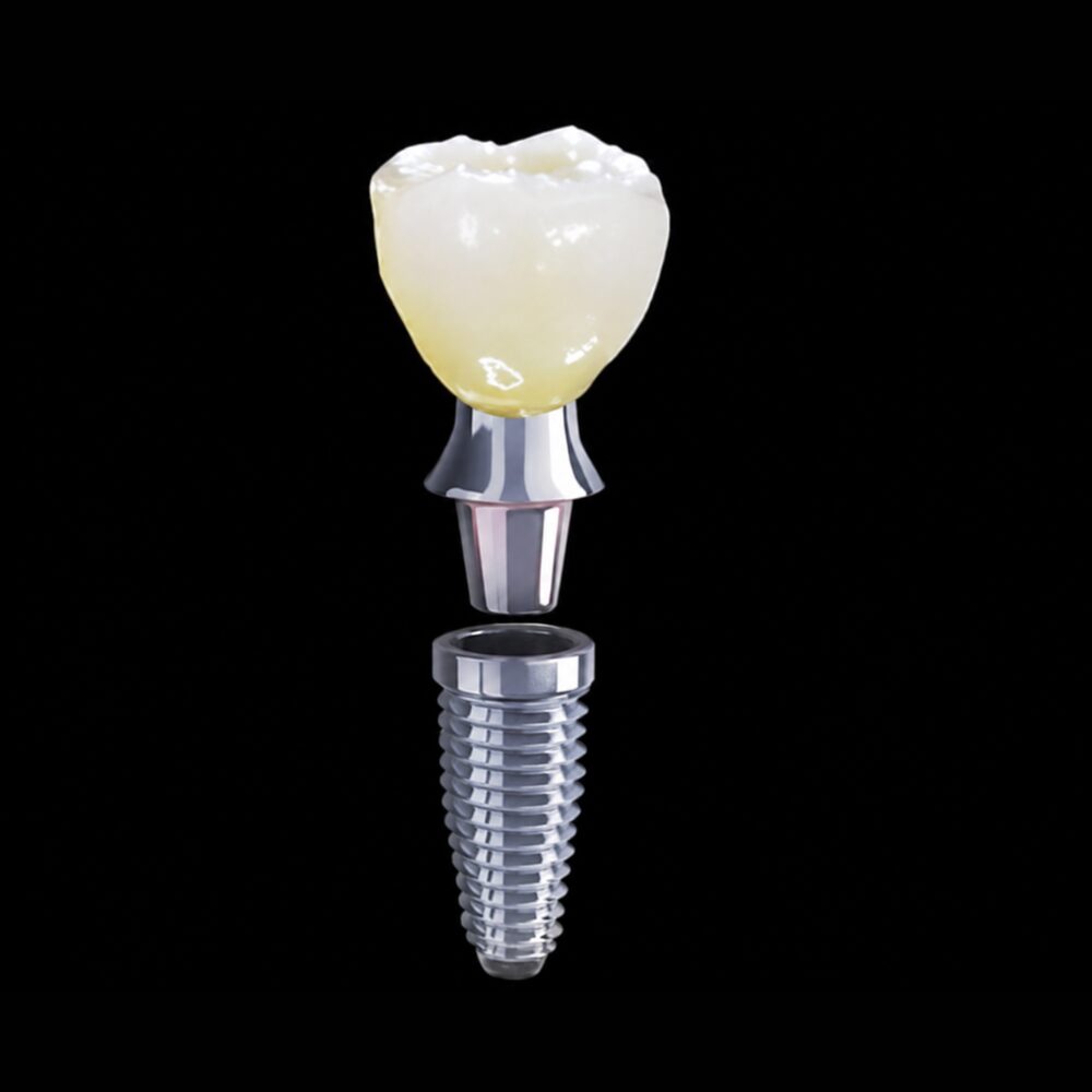 Implant CAD Design