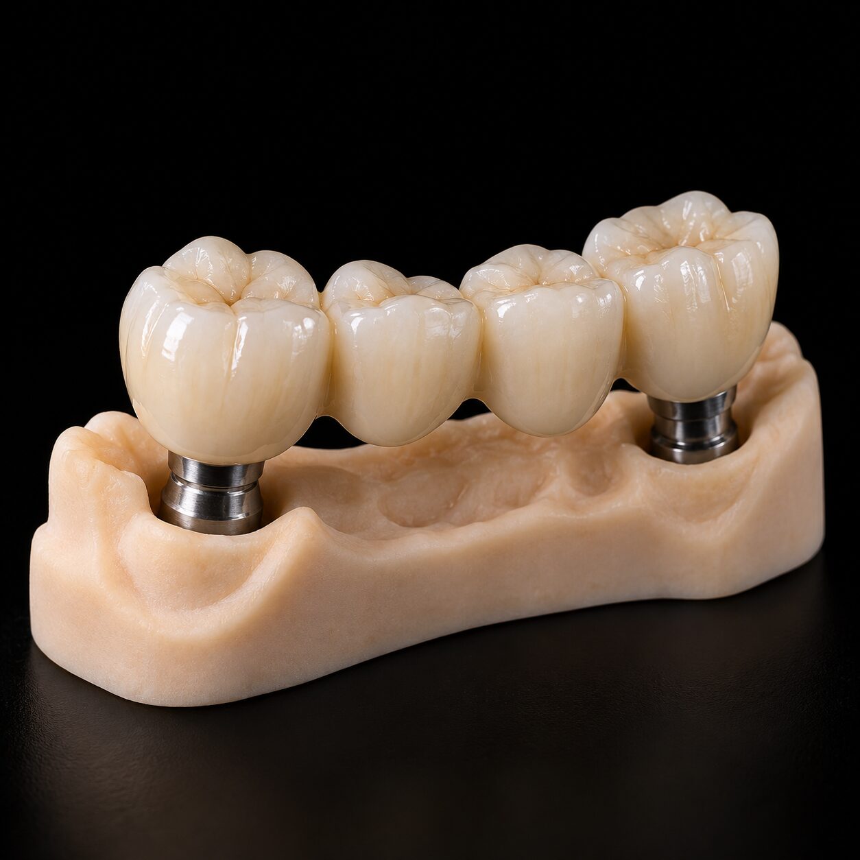 Digital implant supported bridge