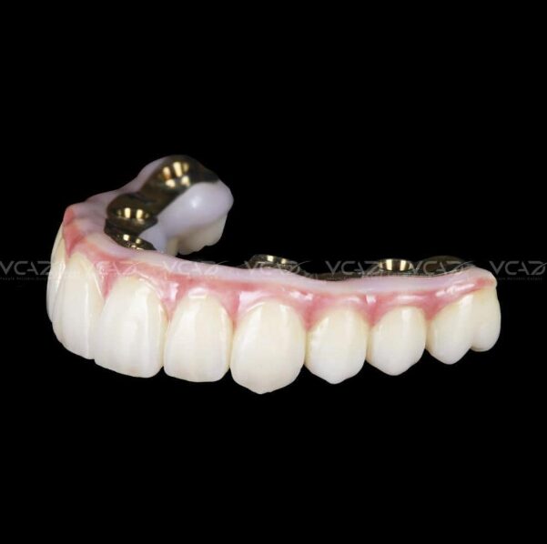 Digital full arch implant restoration