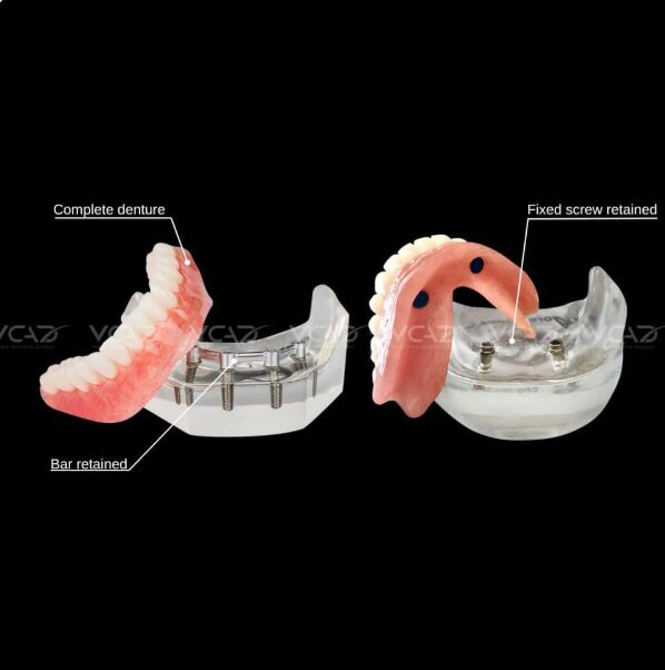Digital overdenture workflow