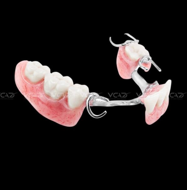 VCAD digital partial denture