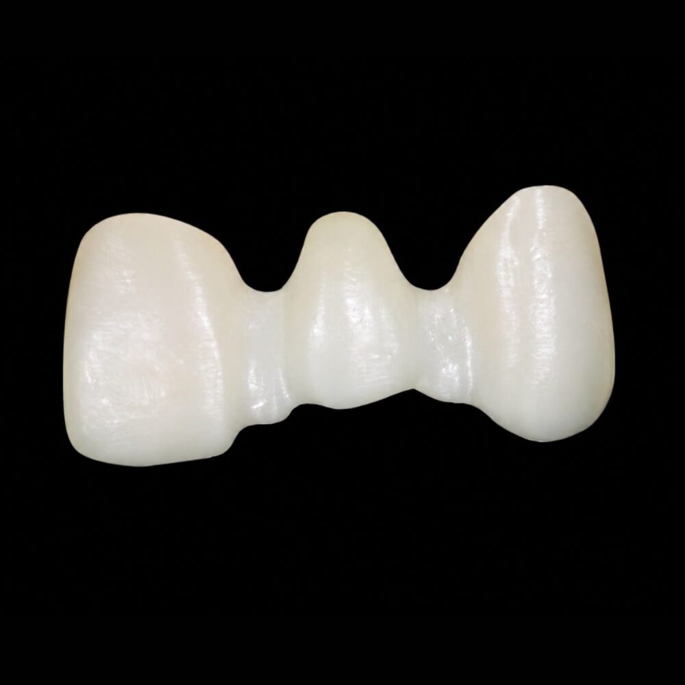Digital dental bridge