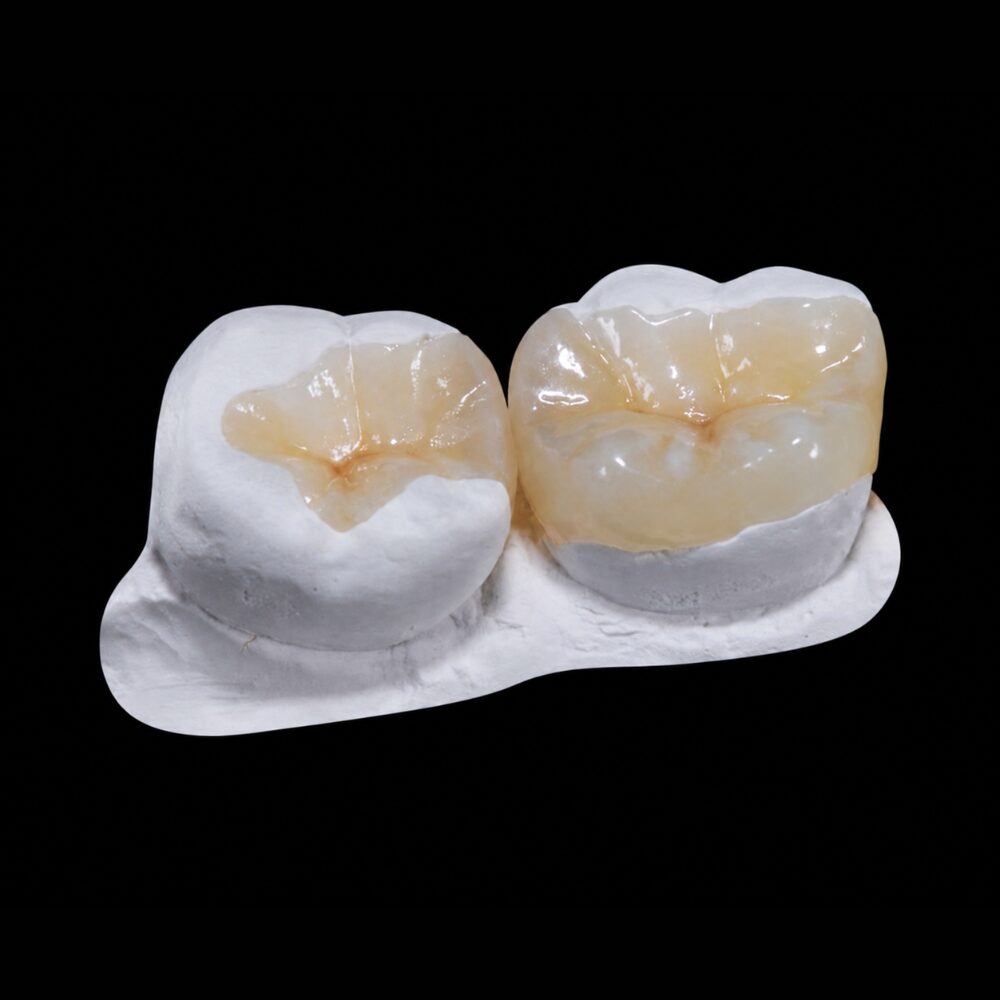 Dental inlay and onlay restoration