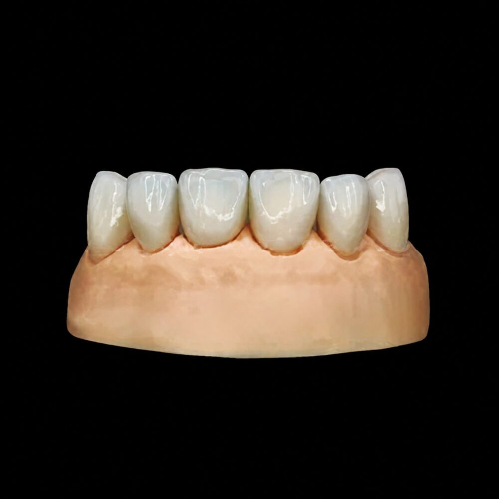Digital dental veneers